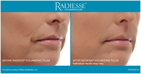 radiesse adalah|Dermaluxe Clinic » Radiesse.